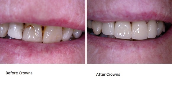 Crowns 1 - before and after.jpg