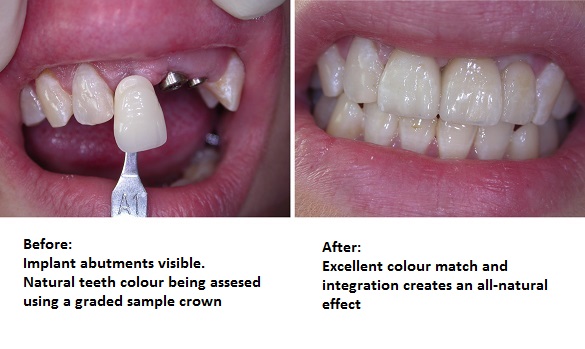 Triple implants - before and after.jpg